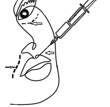 Filler injection sites for facial contouring and volume restoration.