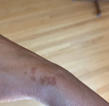 a person's wrist showing faded spots of light brown, with pink at the center, 2 weeks of healing from an inflamed response