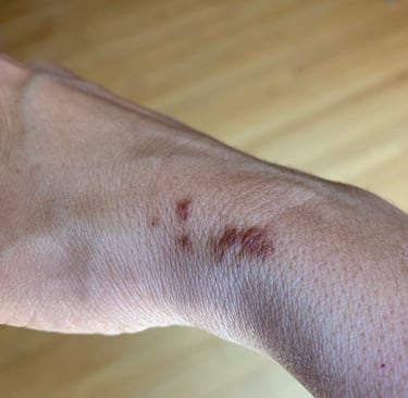 dark spots on a person's wrist, an inflammation response