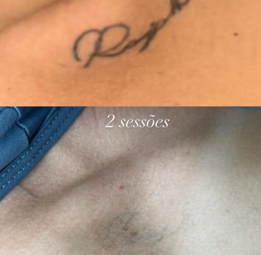 resultado de remocao de tatuagem
