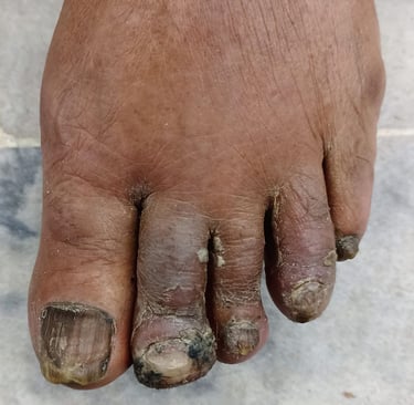 what is perniosis