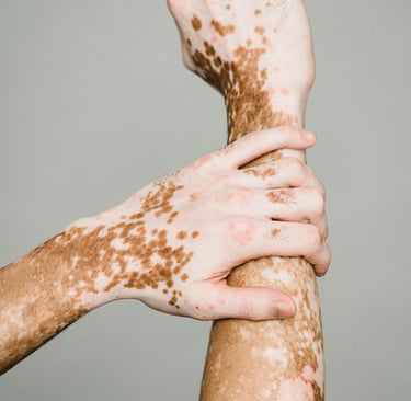 vitiligo treatment in pakistan