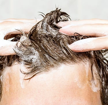 greffe de cheveux,زراعة الشعر الجزائر, perte de cheveux, تساقط الشعر, clinique greffe de cheveux,prp