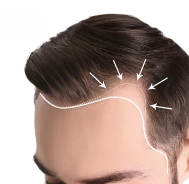 greffe de cheveux,زراعة الشعر الجزائر, perte de cheveux, تساقط الشعر, clinique greffe de cheveux,prp