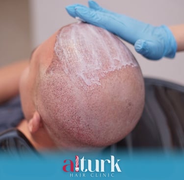 greffe de cheveux,زراعة الشعر الجزائر, perte de cheveux, تساقط الشعر, clinique greffe de cheveux,prp