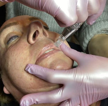 microneedling is de beste anti-age gezichtsbehandeling