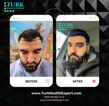 hair transplant before and after