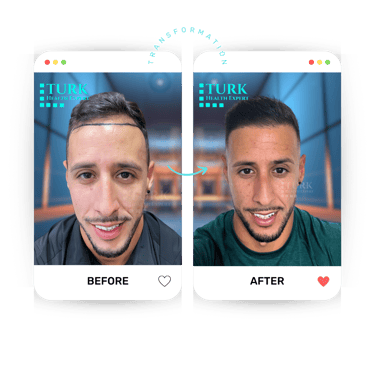 before after hair transplant