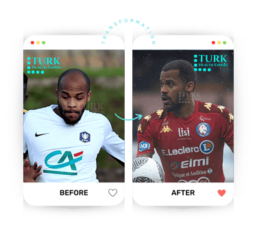 لاعب قبل وبعد زراعة الشعر