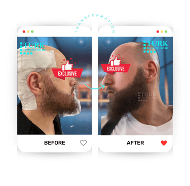 Celebrities beard Transplant