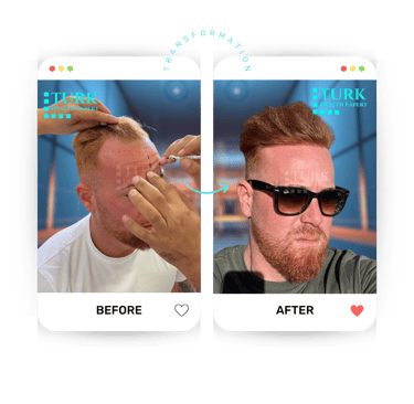 Celebrities Hair Transplant