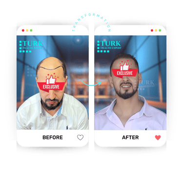 Celebrities Hair Transplant