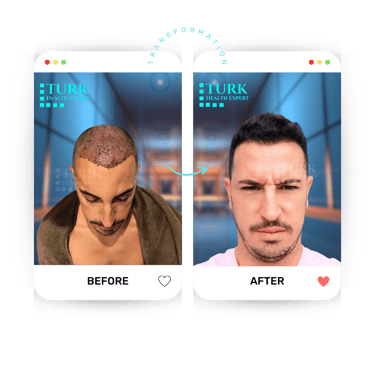 Celebrities Hair Transplant