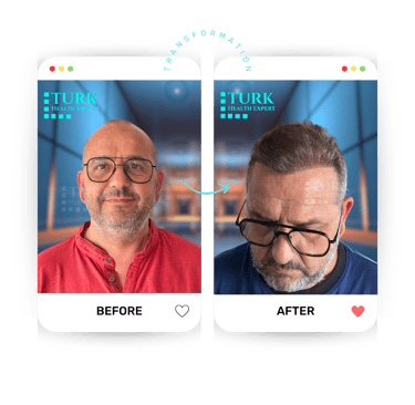 Celebrities Hair Transplant