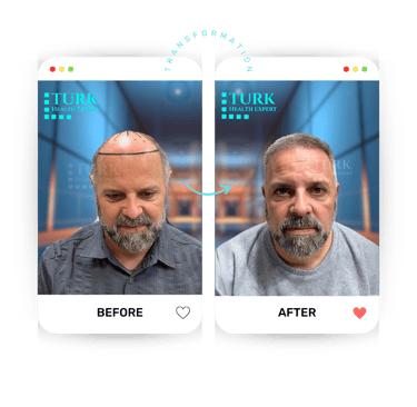 Celebrities Hair Transplant
