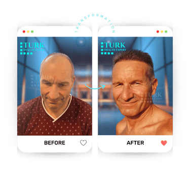 Celebrities Hair Transplant