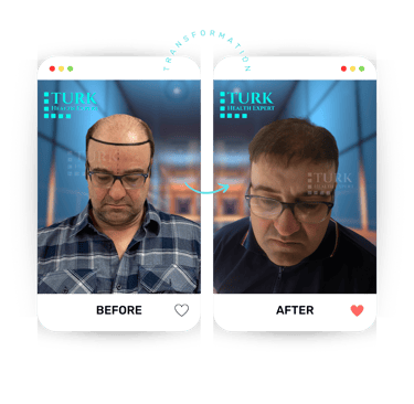 Celebrities Hair Transplant