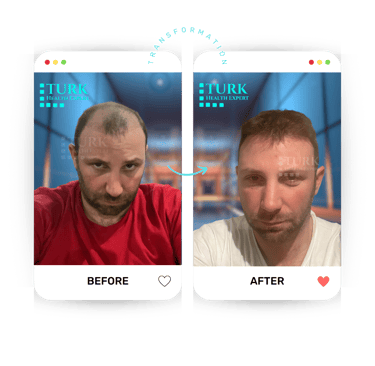 Celebrities Hair Transplant