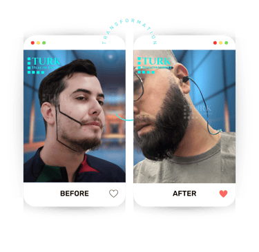 Celebrities beard Transplant