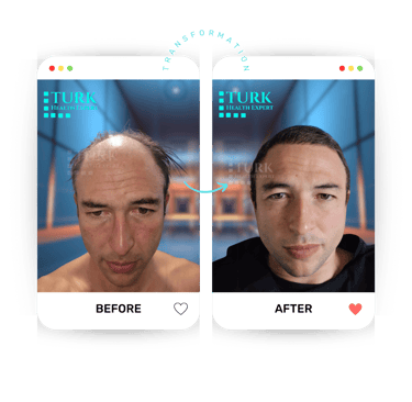 Celebrities Hair Transplant