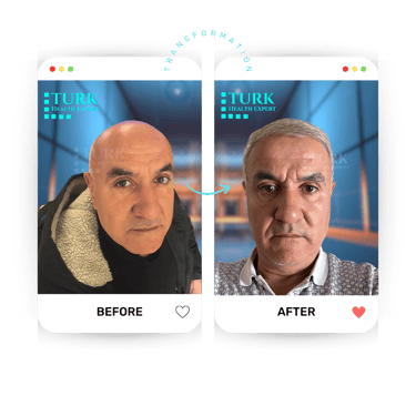 Celebrities Hair Transplant