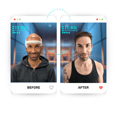 Celebrities Hair Transplant