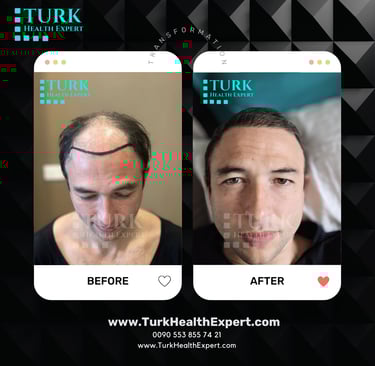 before after hair transplant