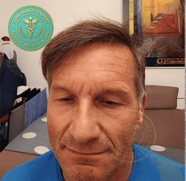 resultat de 1 ans apres la greffe de cheveux pour les seniors de plus de 50 ans