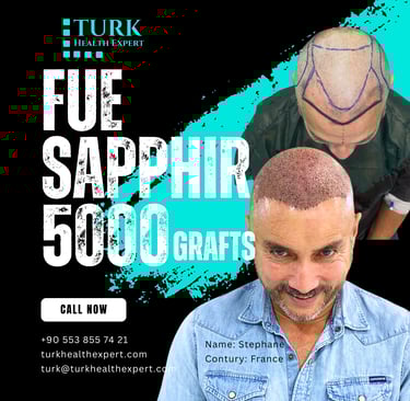 before & after hair transplant 5000 grafts