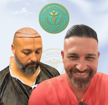 before and after hair transplant turkey