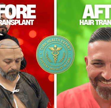 foto de antes y despues el injerto capilar con la FUE