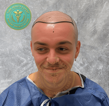 greffe de cheveux avant motif norwood 5