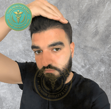 meme persone apres 3 mois de sa greffe de cheveux sans rasage DHI