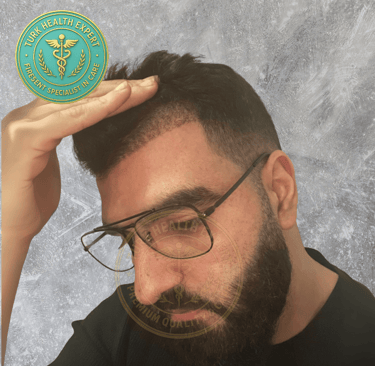 meme persone 15 jours apres sa greffe de cheveux sans rasage DHI