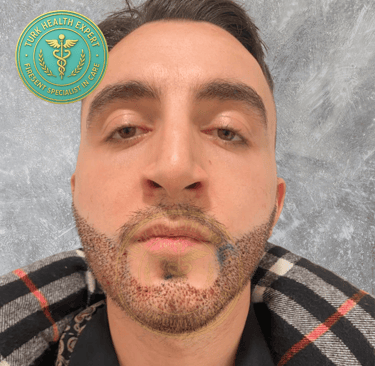 jeune homme 2 eme jour de la greffe de barbe
