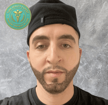 phot de jeune homme 15 jours apres la greffe de barbe