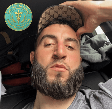 resultat de la greffe de barbe avec la dhi