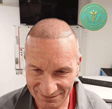 homme seniors de plus de 50 ans 15 jour apres la greffe de chevux