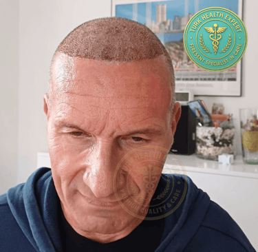 greffe de cheveux seniors apres 50 ans