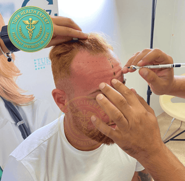 calvitie dans ligne frontale de patient de greffe de cheveux