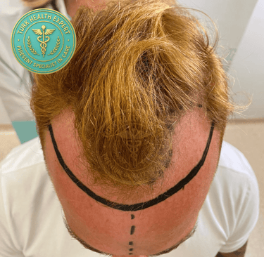 dessine naturelle de la ligne frontal avant lagreffe cheveux