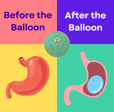 the estomac before and after gastric Balloon