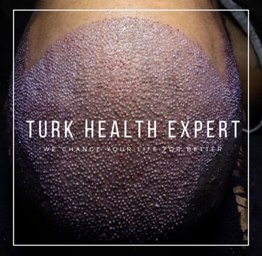 Turkey hair transplant cost