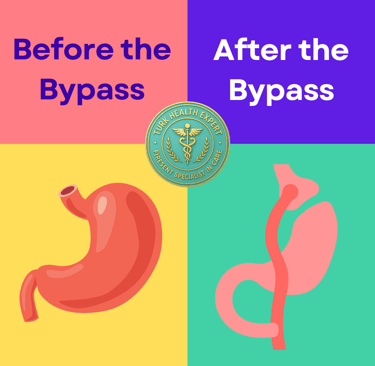 the estomac before and after gastric bypass
