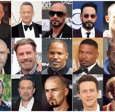 Celebrities hair transplants before and after
