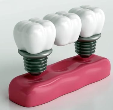 Implant supported bridge