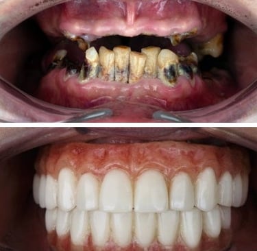 All-on-4-dental-implants