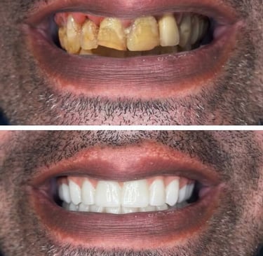 Snap on Dentures