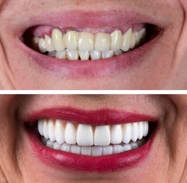 Smile makeover with veneers