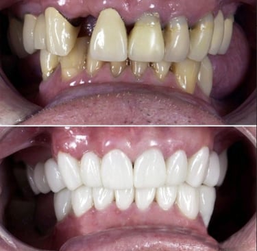 Dental Crowns hollywood smile